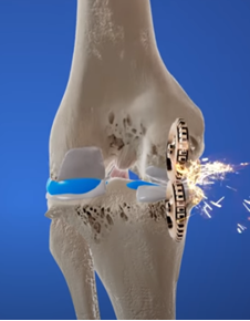 分類圖片 關於O型腳