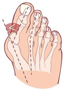 分類圖片 關於拇趾外翻