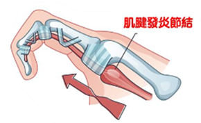分類圖片 關於板機指
