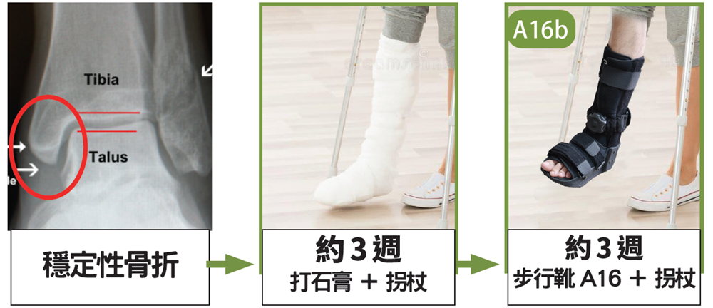足踝骨折