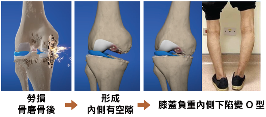 O型膝形成示意