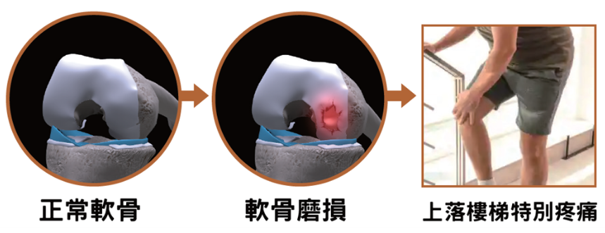 活動時膝內側疼痛