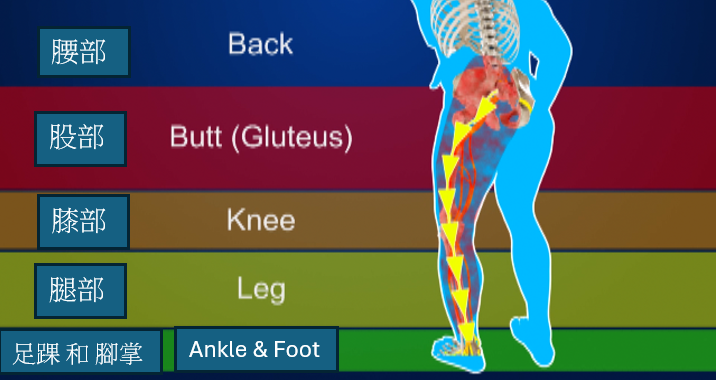 sciatica