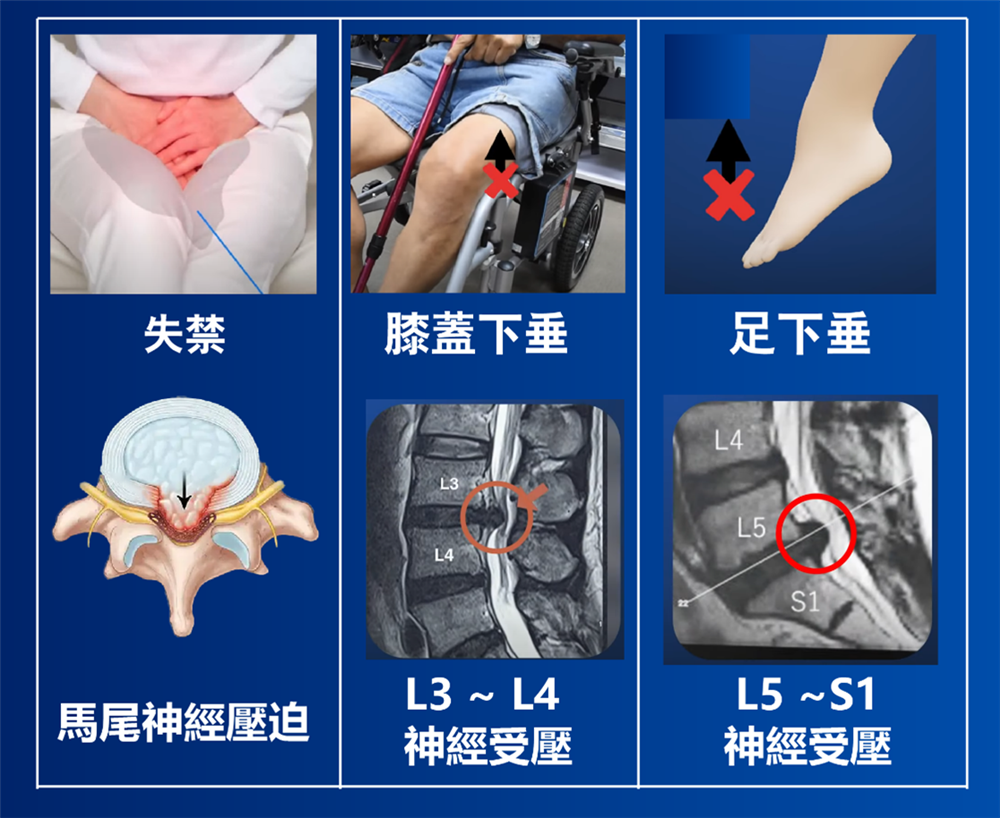 嚴重坐骨神經痛