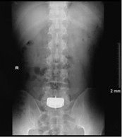Artifical Disc Replacement