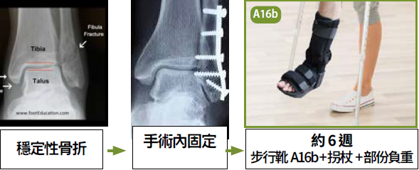 足踝穩定性骨折復康示意圖