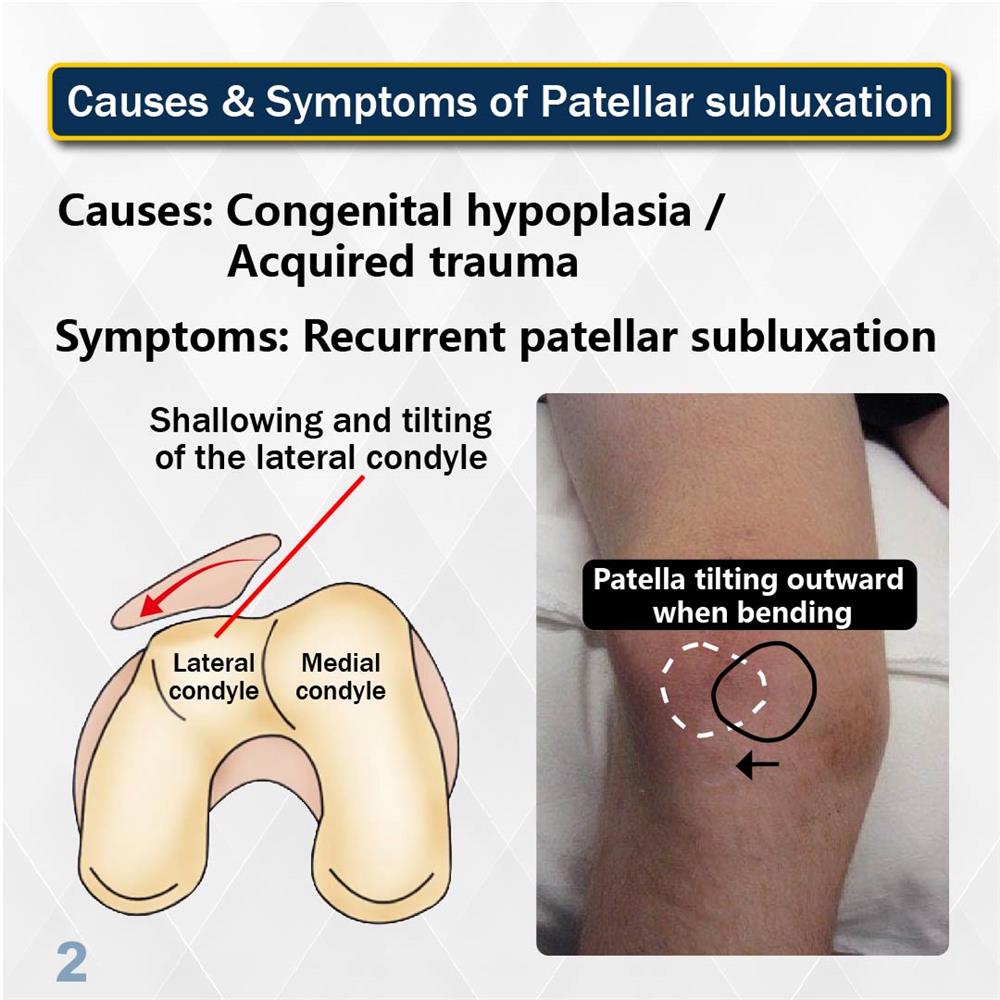 Medex. Patella malalignment , dislocation , subluxation , 髕骨鬆脫外移