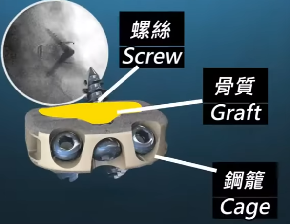 前路脊椎融合手術